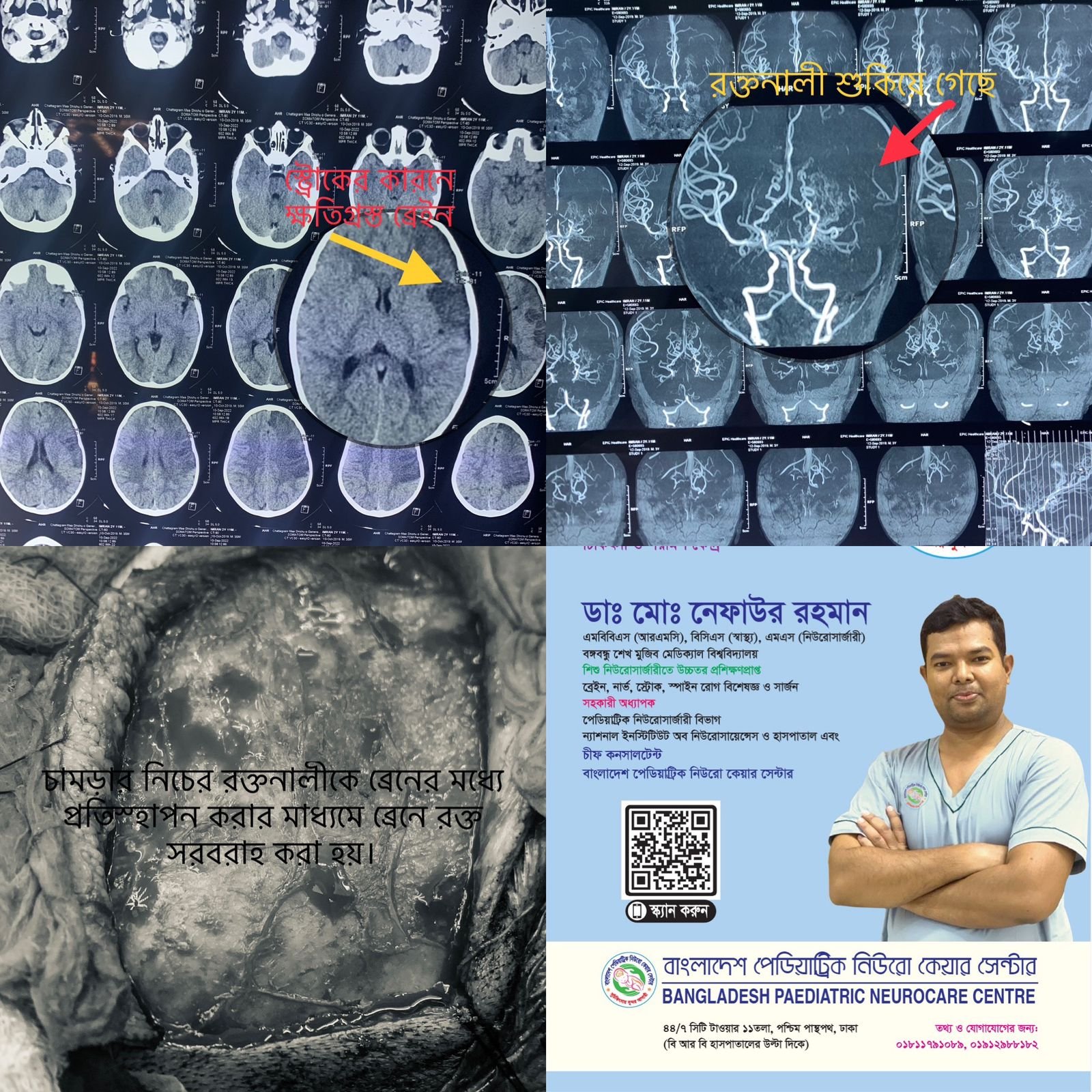 ময়াময়া (Moyamoya Diseases)রোগীর উপসর্গ কি কি?