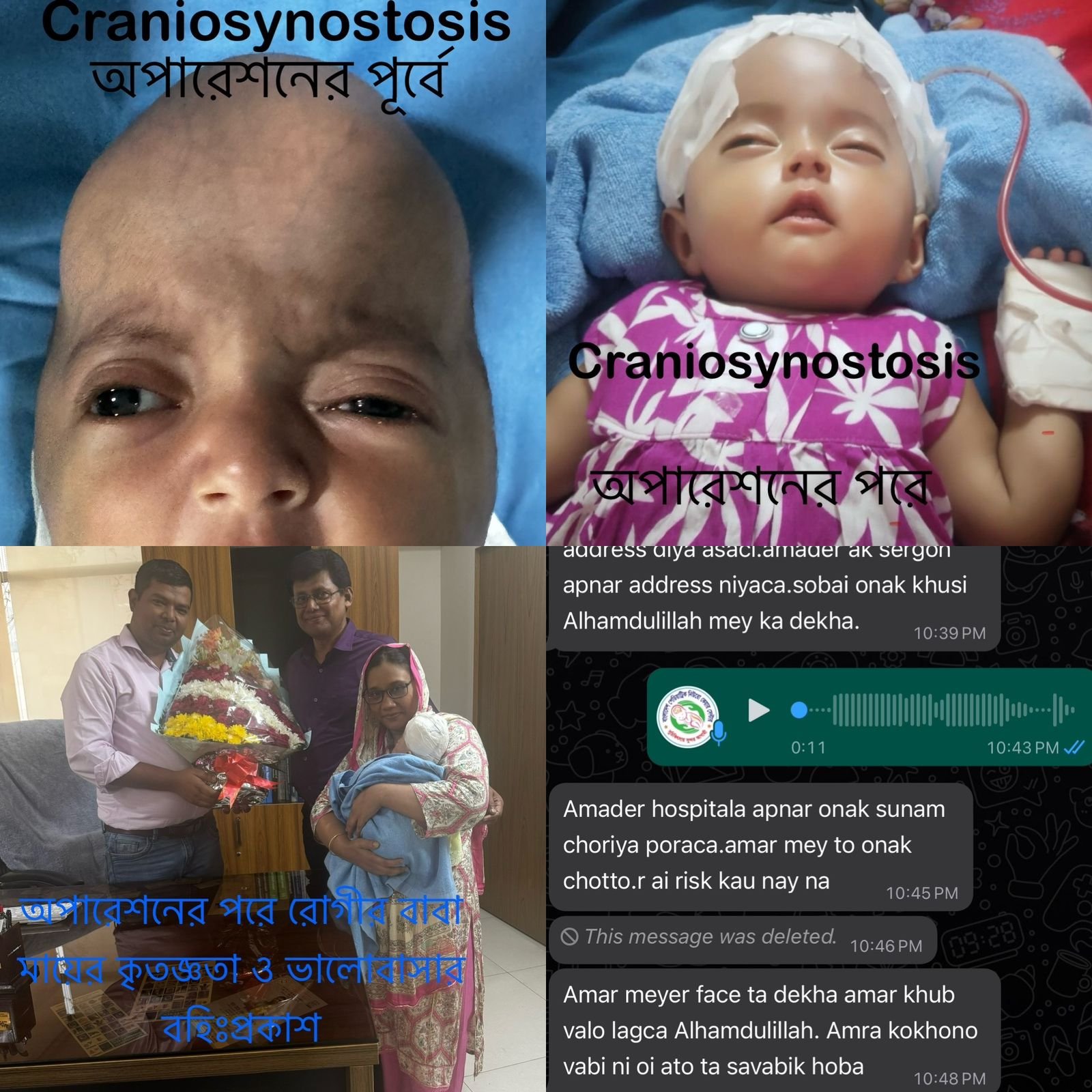 ক্রেনিওসাইনোসটোসিস (Craniosynostosis) রোগের চিকিৎসা বাংলাদেশেই সম্ভব।