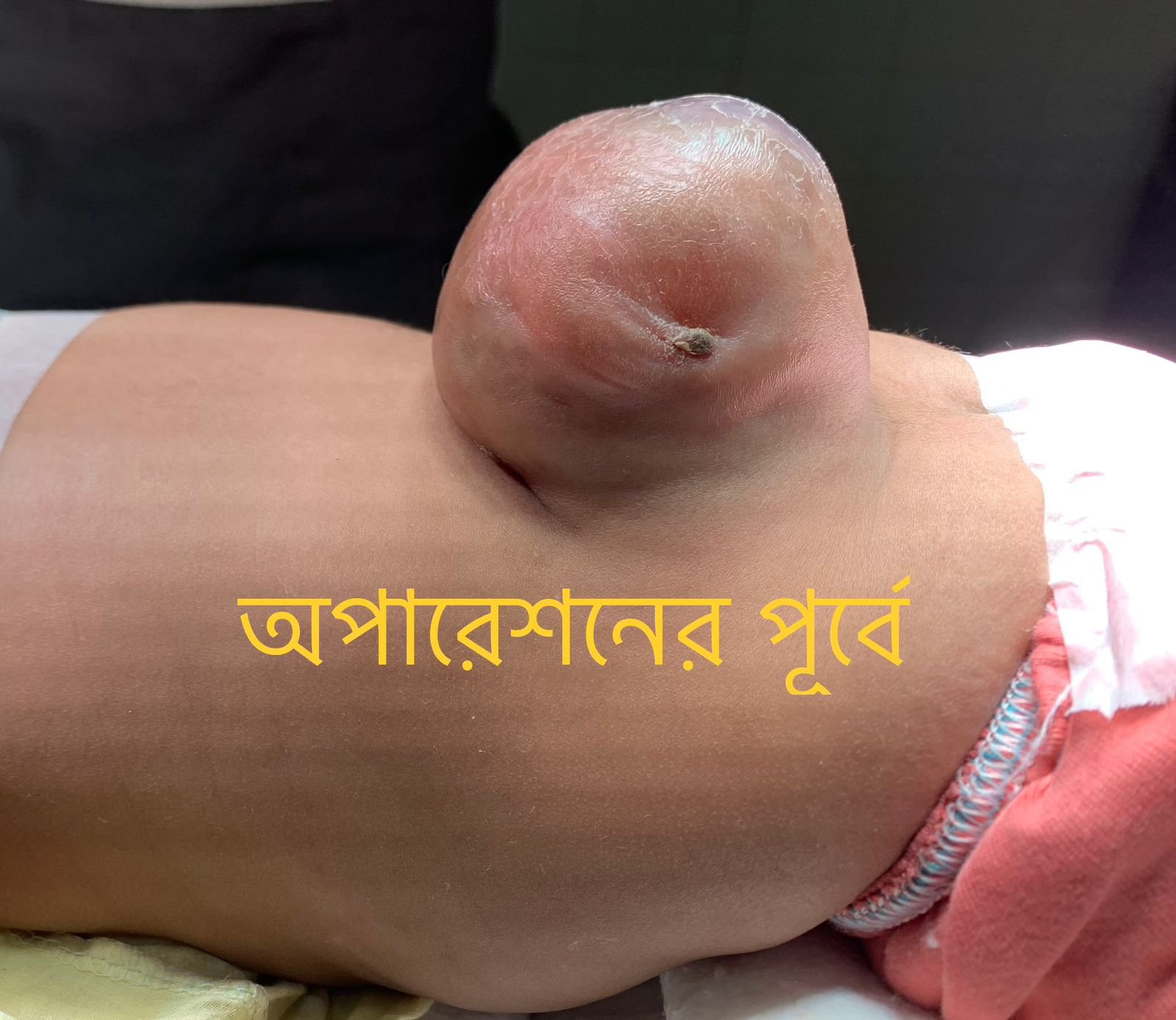 মায়েলোমেনিঙ্গোসিল (Myelomeningocele) কি এবং কেন হয়?